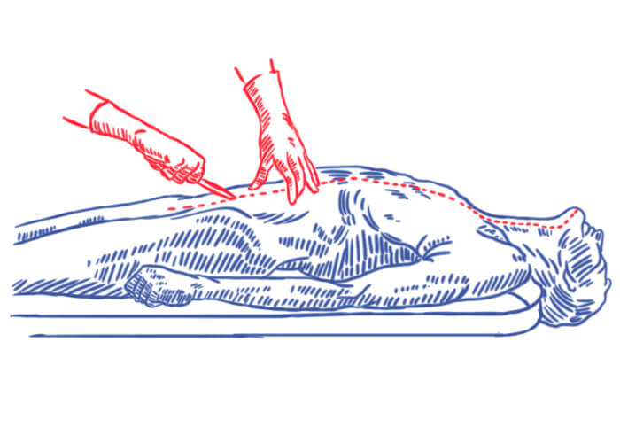 Что такое патологоанатомическое вскрытие